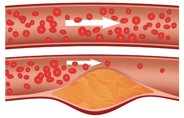 Kā saprast savus holesterīna rezultātus? holesterīna norma