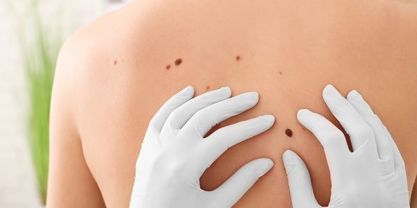 melanoma