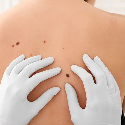 Melanoma – viltīga un agresīva, bet uzveicama melanoma
