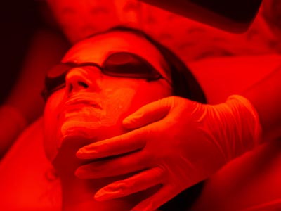 Dermapen procedūra ar sarkano gaismas terapiju
