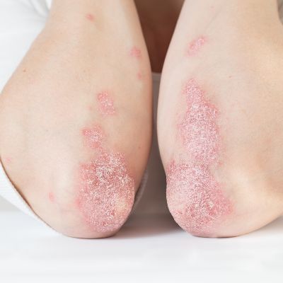 psoriaze uz elkoniem