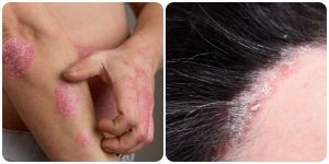 Psoriāze: kā sadzīvot un mazināt psoriāzes simptomus? Psoriāze